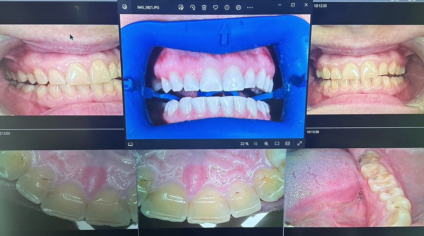 отбеливание zoom4 фото до и после